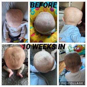10-weeks-in-Technology-in-Motion-Plagiocephaly-300x300