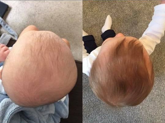 Plagiocephaly Before and After Treatment Pictures