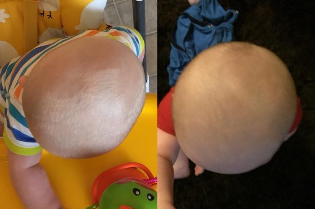 Jake-before-and-after-plagiocephaly-treatment