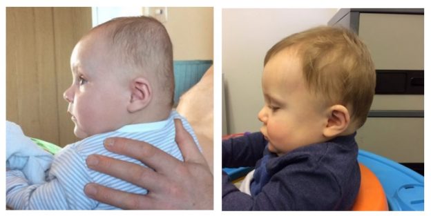 Plagiocephaly Before and After Treatment Pictures