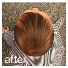 Ollie-After-flat-head-treatment