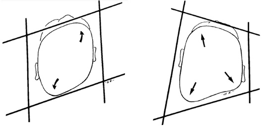 huang-posterior-plagiocephaly