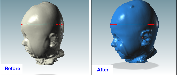 Before & After use of plagiocephaly helmet