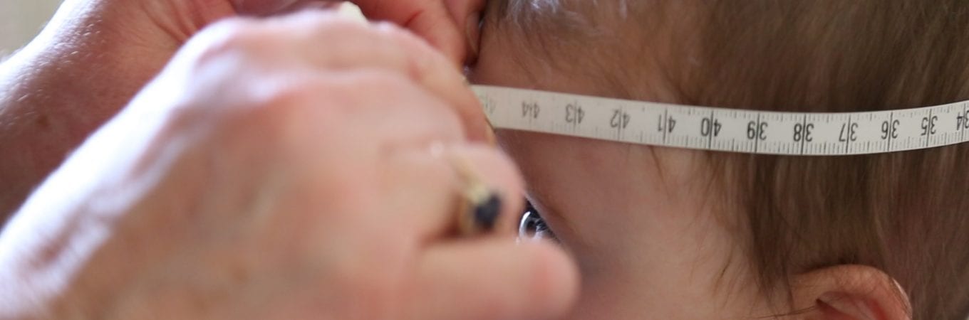 Classifying Plagiocephaly