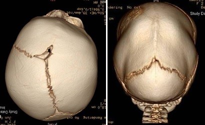 Difference-Between-Plagiocephaly-and-Craniosynostosis