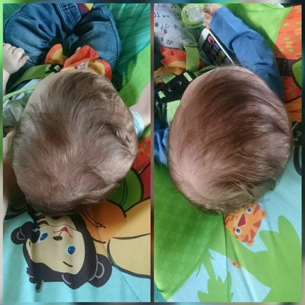 Plagiocephaly Before and After Treatment Pictures