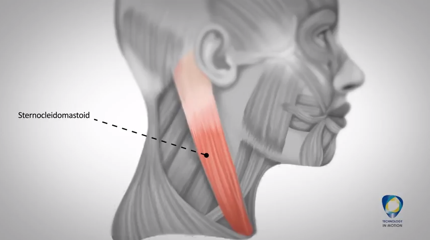 Sternocleidomastoid