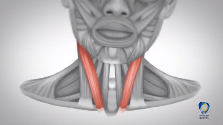 Torticollis-1