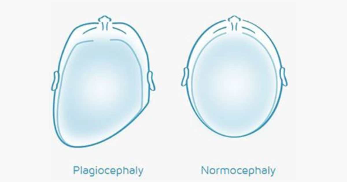Normocephaly Explained: What is a Normal Head Shape?