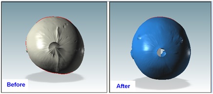 Before and after scans for plagiocephaly treatment