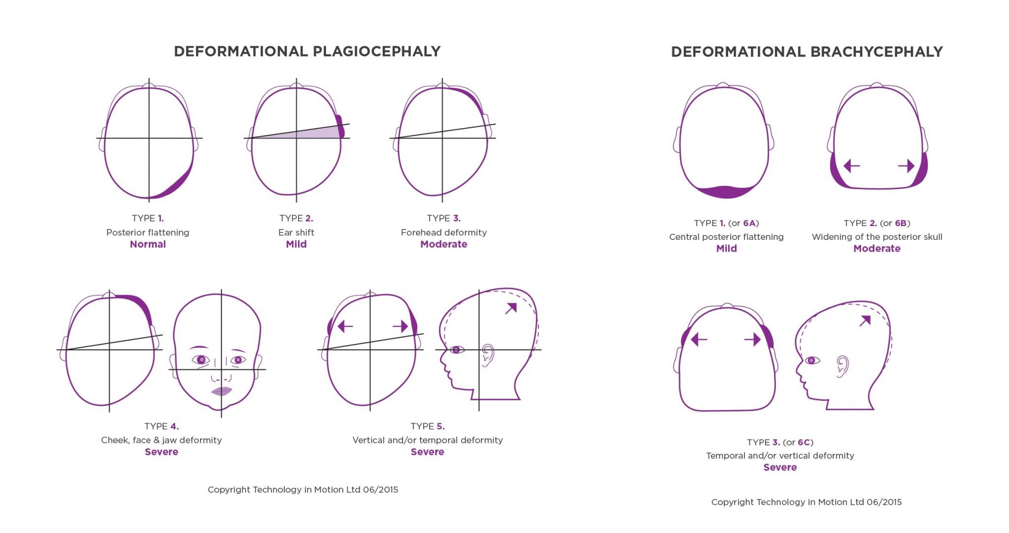 classifying-plagiocephaly-argenta-scale