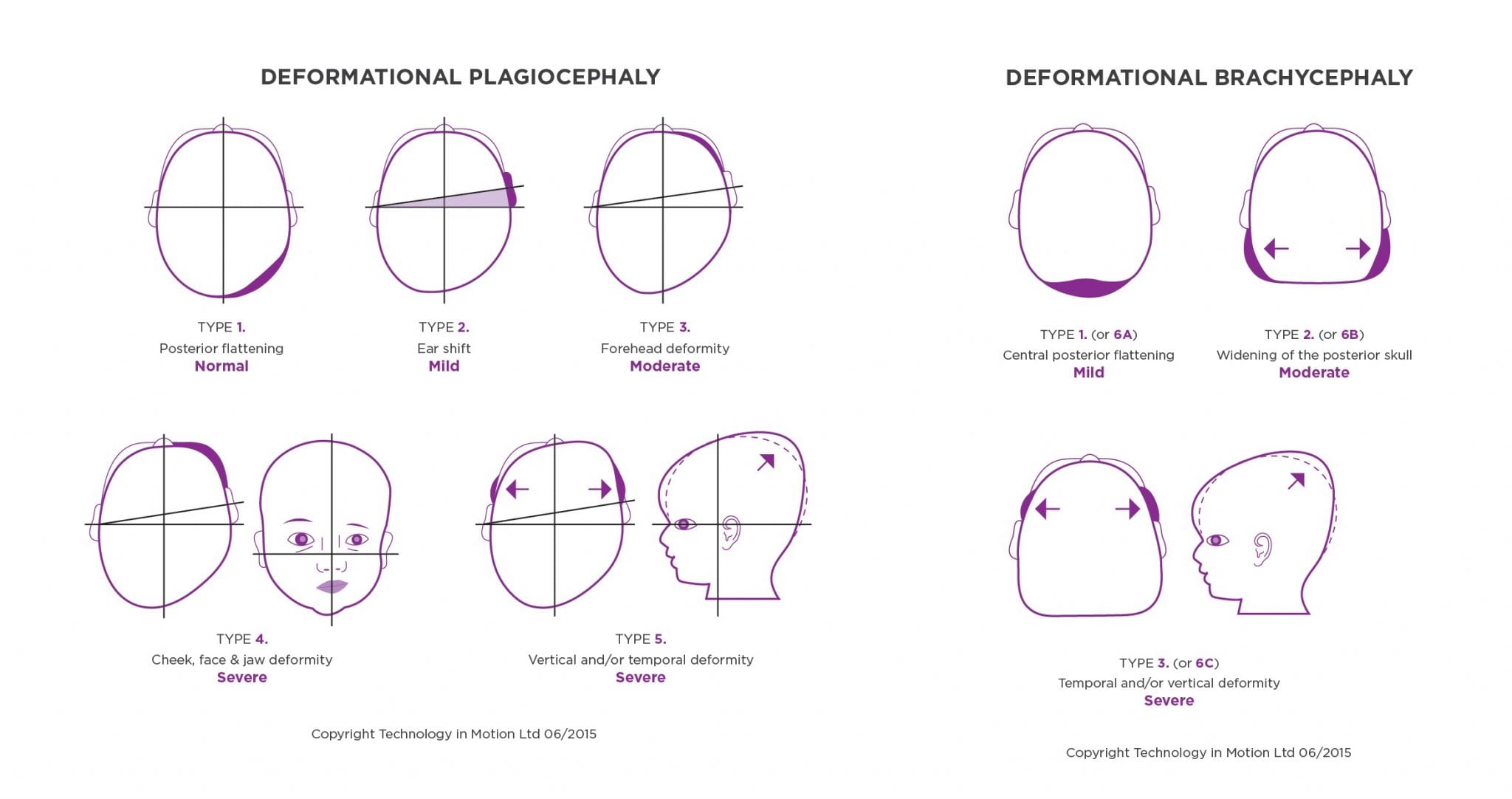 classifying-plagiocephaly-argenta-scale