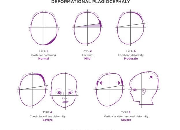 Deformational Plagiocephaly Explained