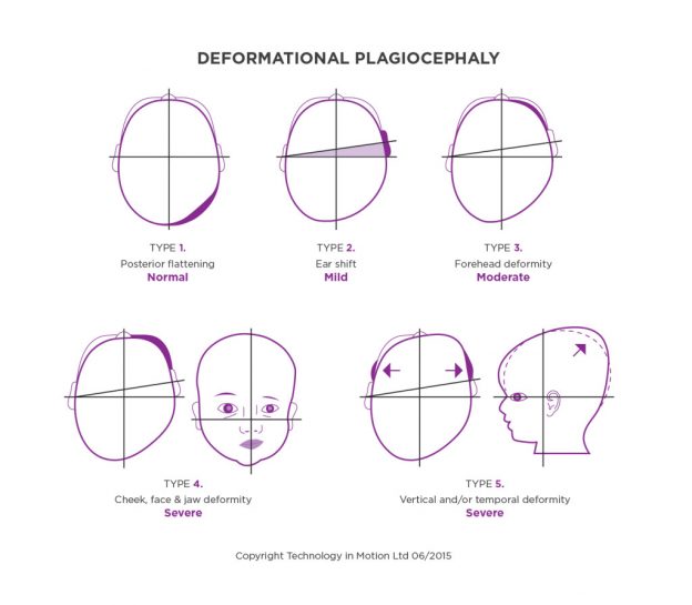 deformational-plagiocephaly-1024x895-624x545