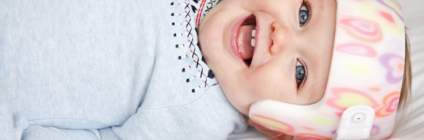 Plagiocephaly in Infants