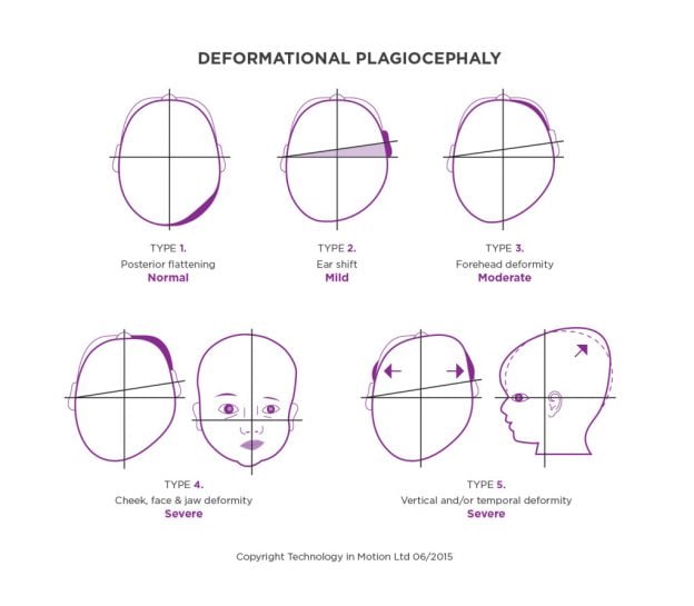 how-to-identify-deformationoal-plagiocephaly-diagram-infographic