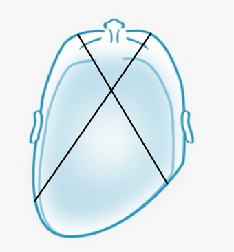 how-to-identify-plagiocephaly