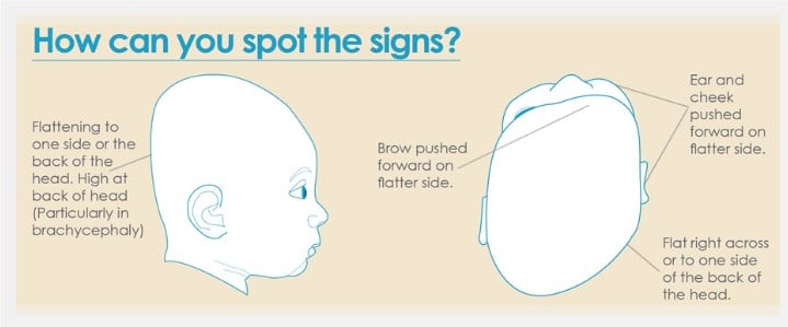 how-to-spot-plagiocephaly-