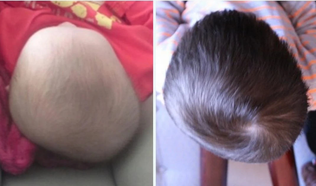 long-term-affects-of-plagiocephaly