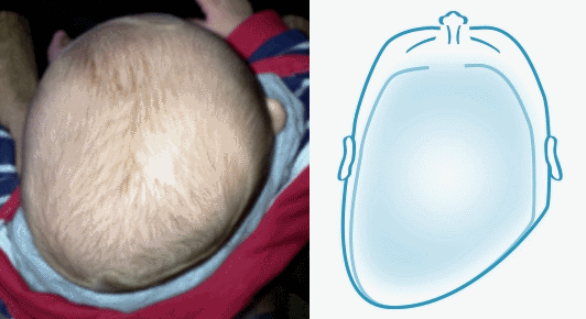 plagiocephaly-comparison