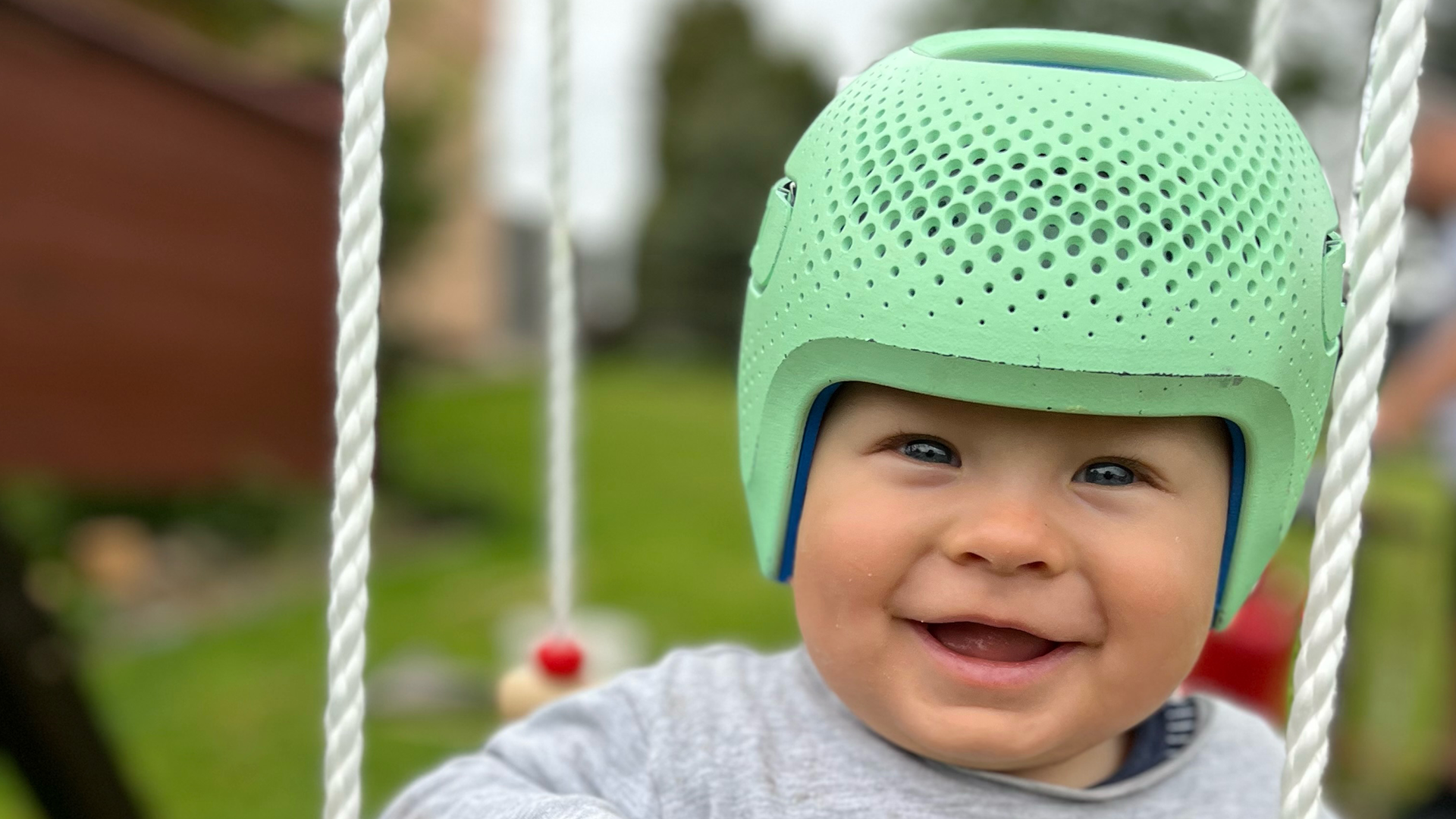 Plagiocephaly Facial Asymmetry | Deformational Plagiocephaly