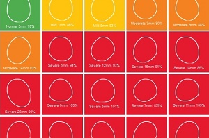 plagiocephaly-severity-table