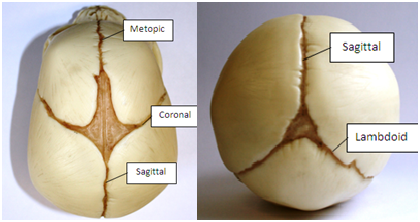 plagiocephaly-vs-craniosynotosis