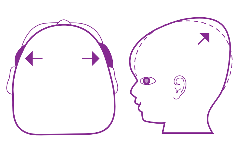 servere deformity head shape baby