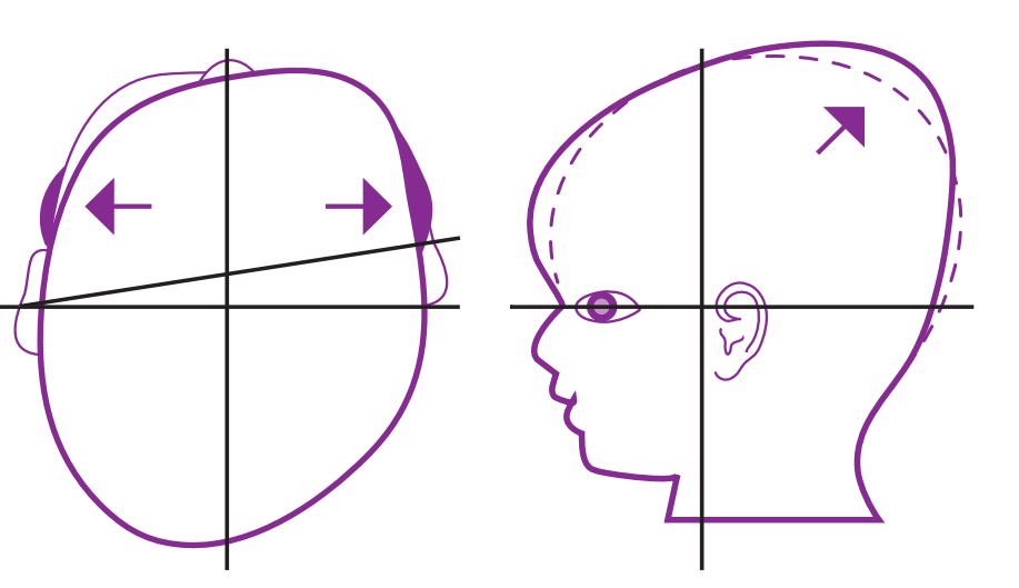 severe head shape baby - temple