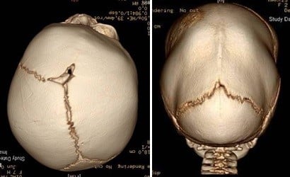 skull-malformations